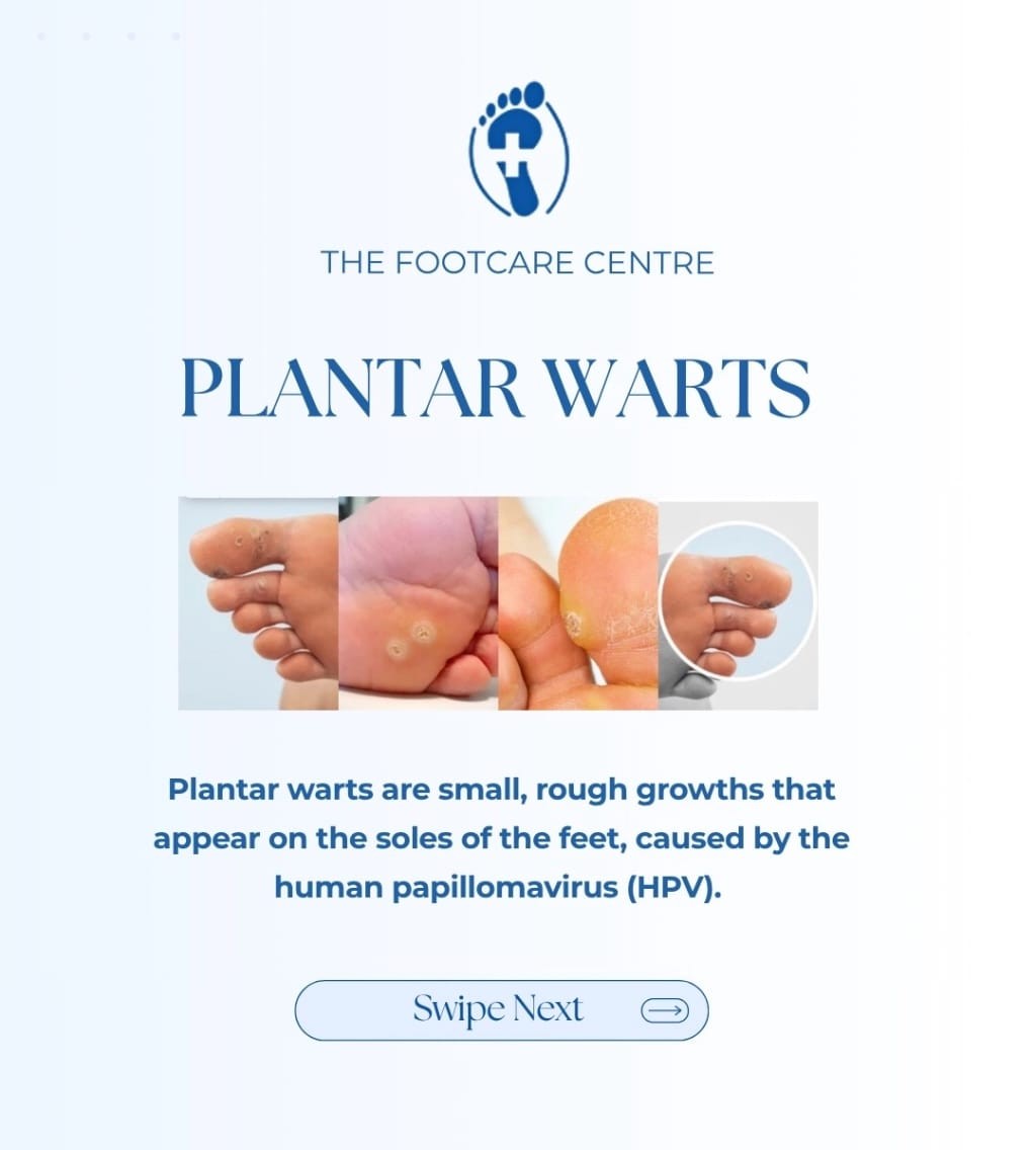 Plantar Warts